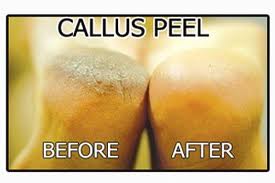 Callus Peel Before & After